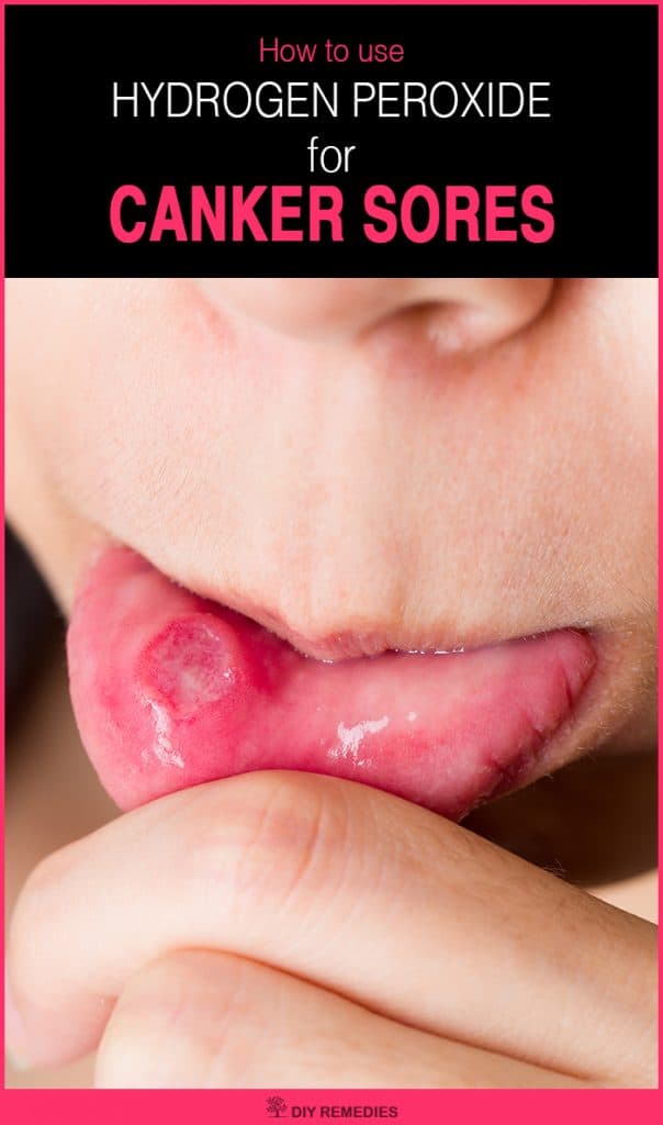 How to Treat Canker Sores using Hydrogen Peroxide