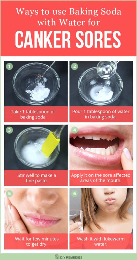 Baking Soda with Water for Canker Sores