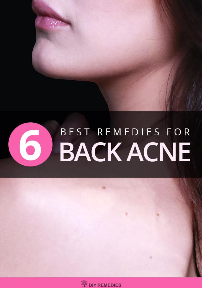 Best Remedies for Back Acne