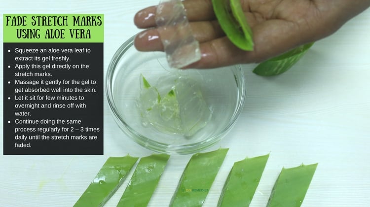 How Aloe Vera Reduces Stretch Marks