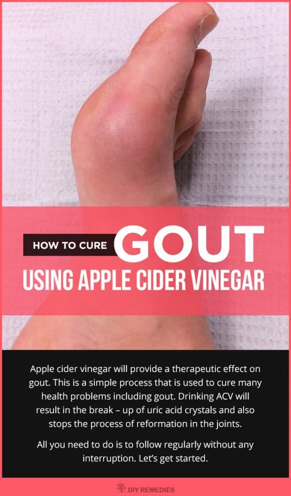 How to Cure Gout using Apple Cider Vinegar
