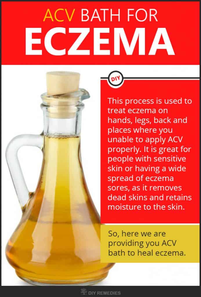 Get Rid of Eczema using Apple Cider Vinegar
