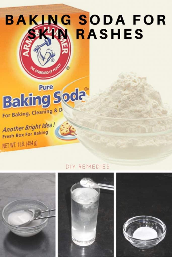 Baking Soda for Rashes