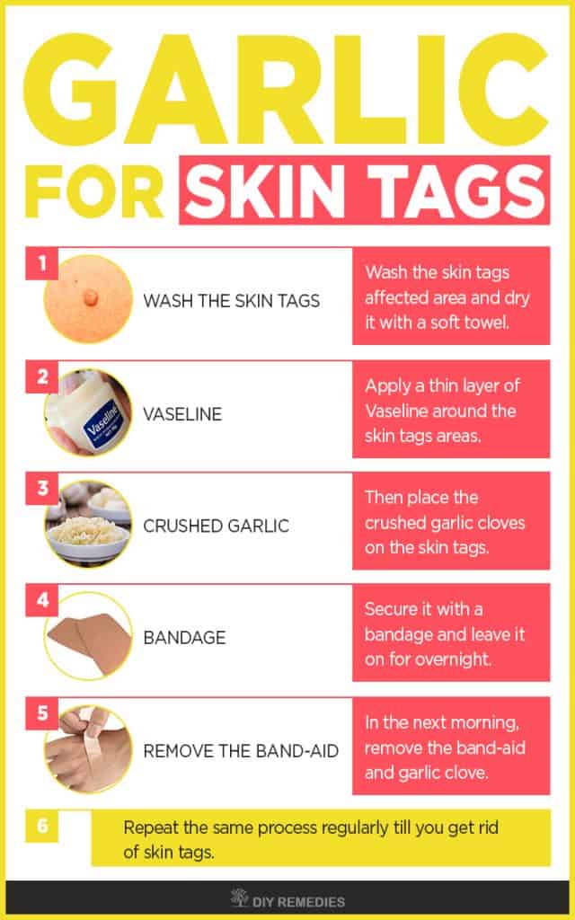 How Does Garlic Removes Skin Tags