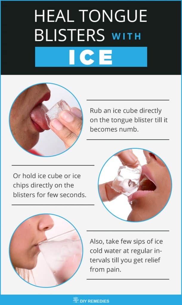 Ice Remedies for Tongue Blisters