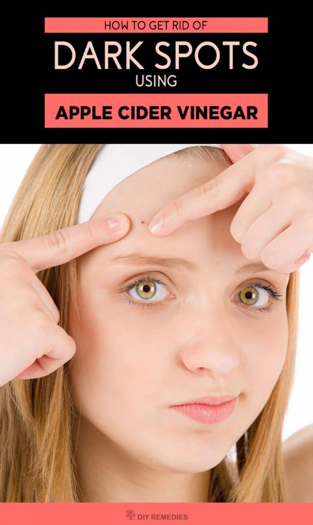 Apple Cider Vinegar for Blackheads Removal