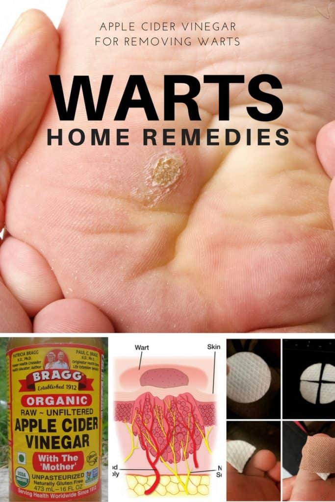 How to use Apple Cider Vinegar for Warts