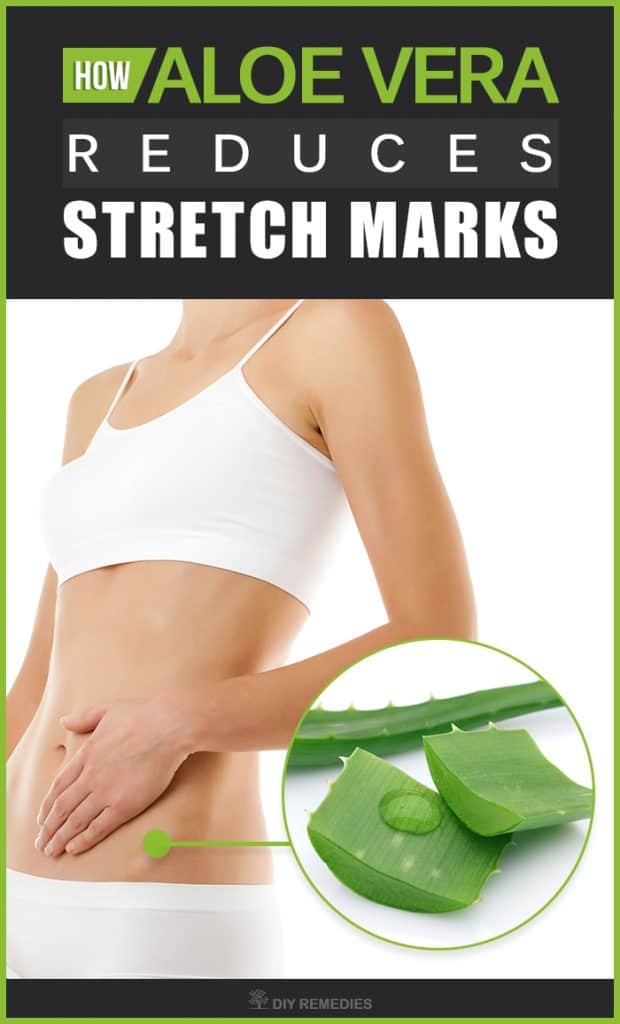 How-Aloe-Vera-Reduces-Stretch-Marks