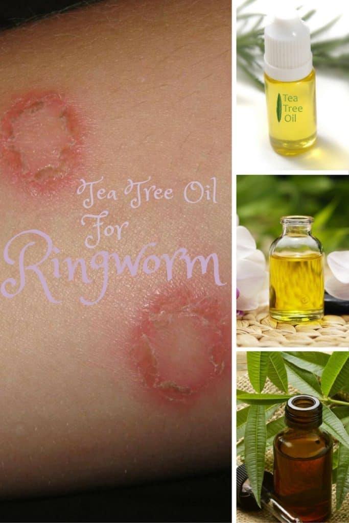 Tea Tree Oil for Ringworm