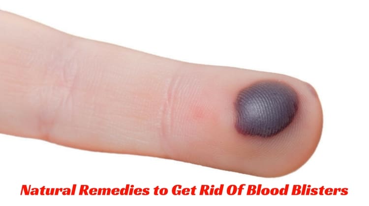 Home Remedies for Blood Blisters