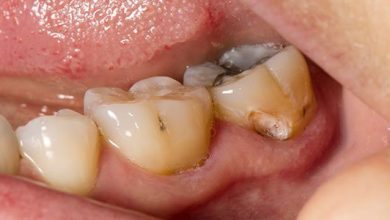 Why Do You Need Braces?