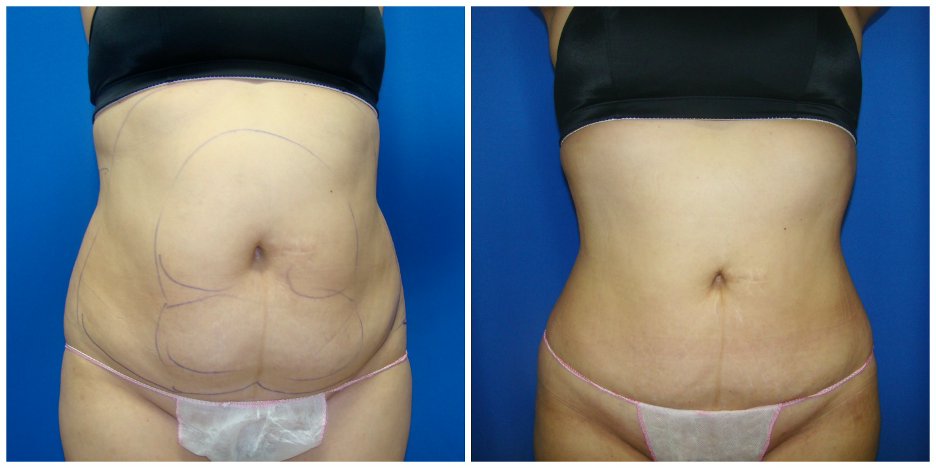 360 houston liposuction procedure