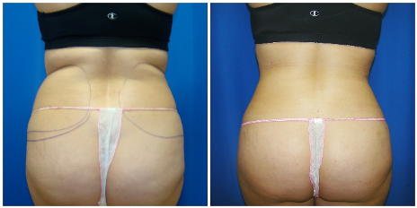 360 houston liposuction procedure