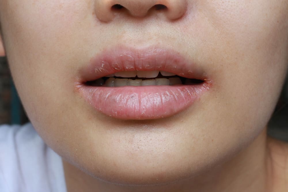 close up of chapped, cracked lips