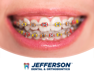 Braces combination red and yellow