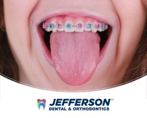 Braces with pink and blue color combination