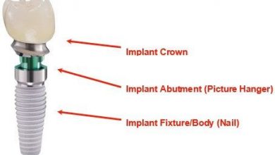 Dental Implant