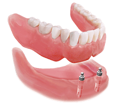 Dental implants on dentures