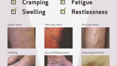 Vein Disease Chart