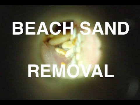Sand beach in the ear, eliminate micro-suction