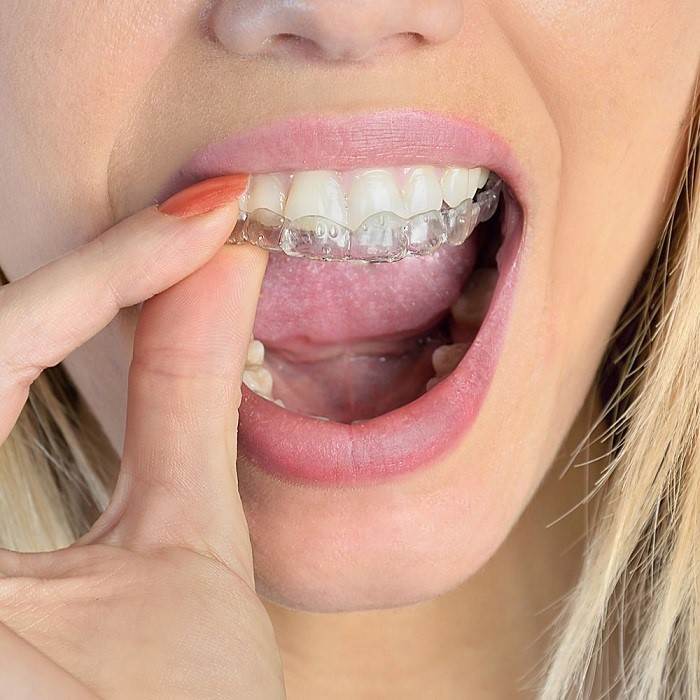 Invisalign