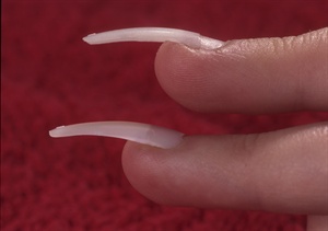 The tip you see on the bottom is untailored, and covers the entire nail. It also puts pressure on, the puffy skin; notice how it's cutting into the skin at the tip of the finger. The top tip has been modified in the contact area so that it covers not more than ore-half of the nail plate. The extension of the tip has been carved out with a file so that it sad-dles the puffy skin without exerting any pressure.