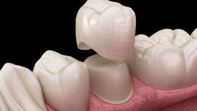 Dental Crowns to make teeth bigger