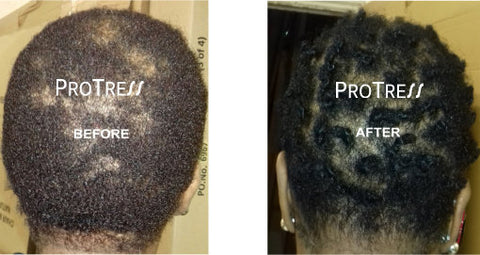central centrifugal cicatricial alopecia treatment